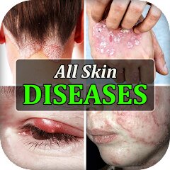 All Skin Diseases & Treatment